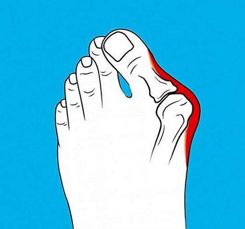 آرتروز مفصل روی انگشت پا