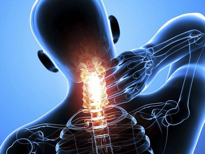 استئوکندروز ستون فقرات گردنی با درد در گردن همراه است