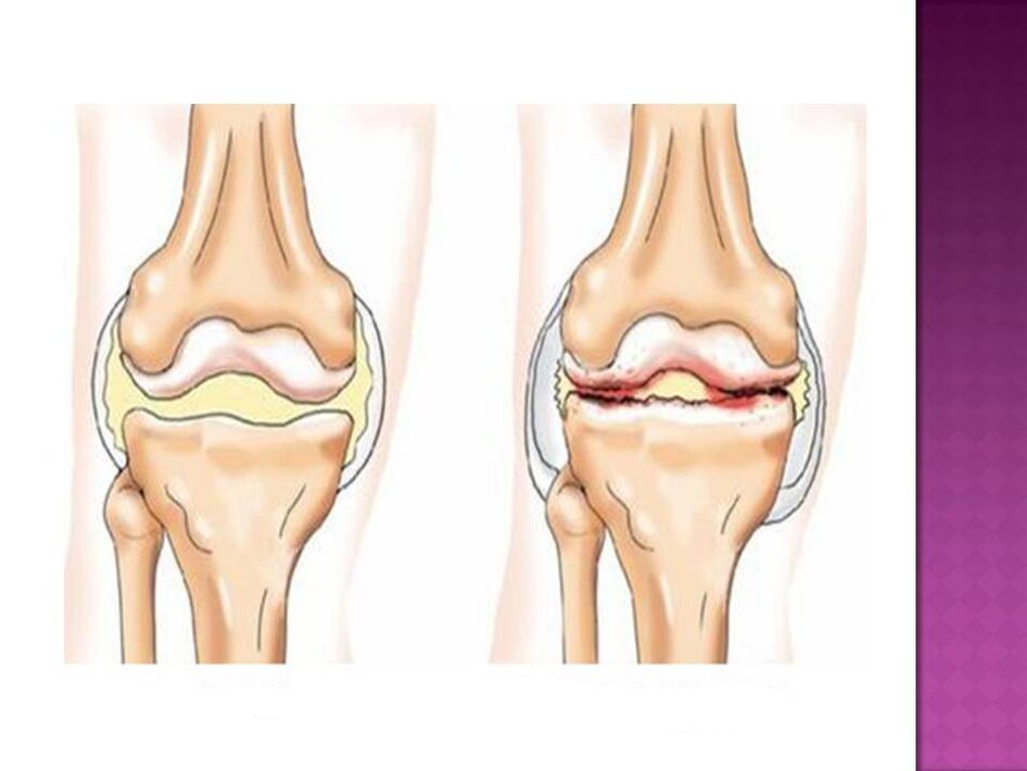 مفصل طبیعی است (چپ) و تحت تأثیر آرتروز (راست) قرار گرفته است. 
