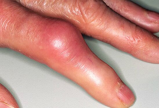 نقرس با درد شدید در انگشتان دست و تورم مفاصل همراه است. 