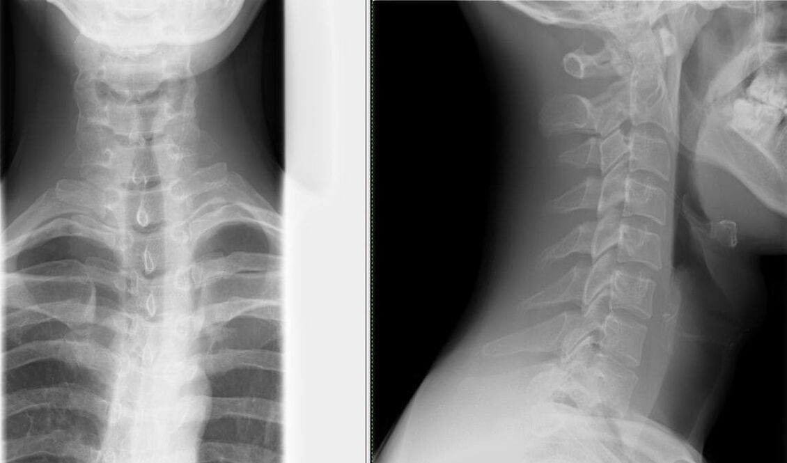 اشعه ایکس از ستون فقرات یک روش ساده و موثر برای تشخیص پوکی استخوان است