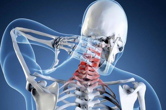 پوکی استخوان ستون فقرات گردنی